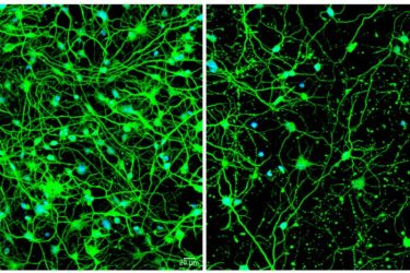 Shown at left are neurons transformed from skin cells of a young patient with pre-symptomatic Huntington's disease. On the right are neurons transformed from skin cells of an older patient with symptomatic Huntington's