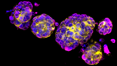 Image showing breast cancer organoid cells