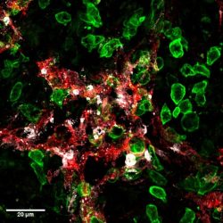 Image: Killer-T cells (green) attack lymphatic vessels (red) in tumours and induce their death (cell death marker in white).