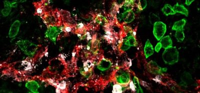 Image: Killer-T cells (green) attack lymphatic vessels (red) in tumours and induce their death (cell death marker in white).