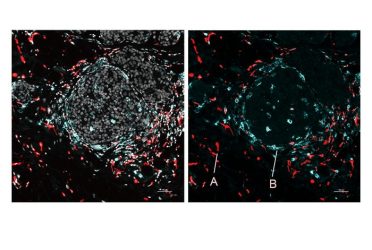 Image of human breast cancer cells showing A) immunosuppressive macrophages near tumor connective tissue, and B) immunostimulatory macrophages near tumor nests.