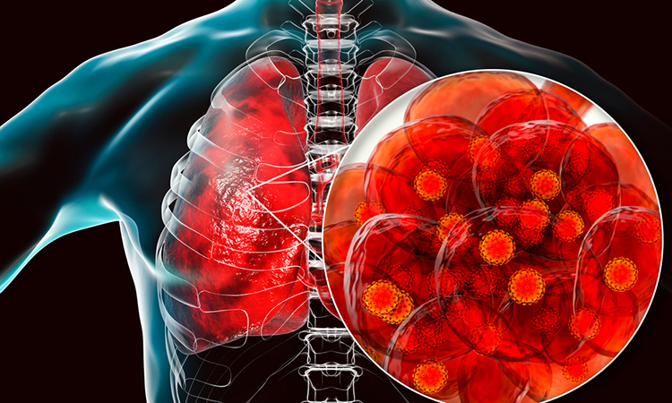 COVID-19 and lungs