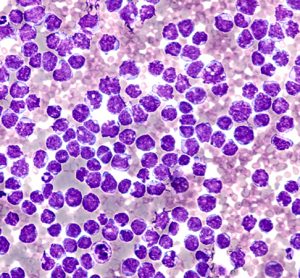 Lymphoma