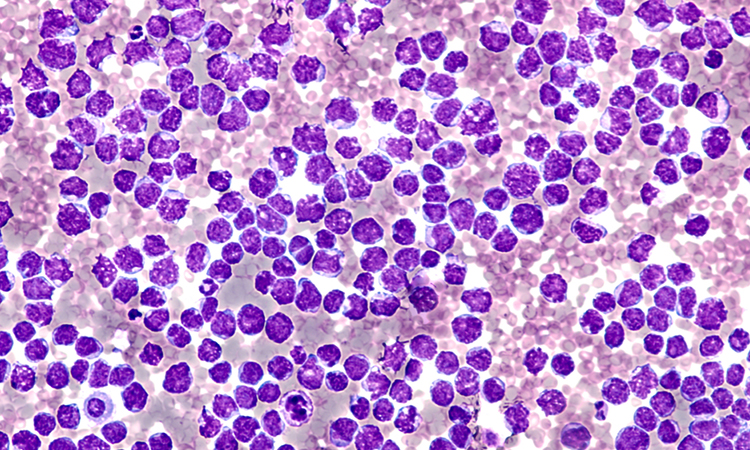 Lymphoma