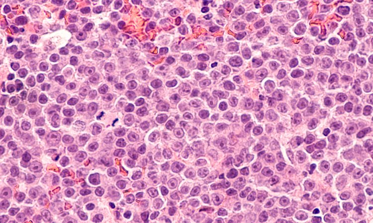 Lymphoma