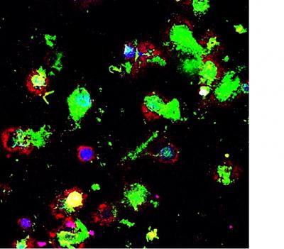 Macrophages Eating Cancer Cells