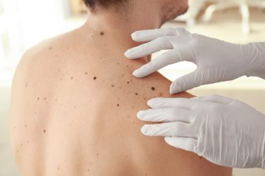 Doctor's gloved hands touching a patient's back as they examine the person's moles for potential melanomas