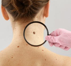 Melanoma