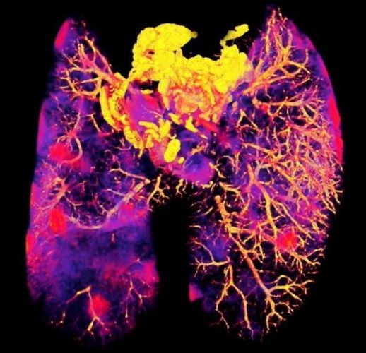 Mycobacterium tuberculosis infected mouse lungs. A computed tomography scan of mouse lungs infected with Mycobacterium tuberculosis. Red inclusions indicate the location of granulomas within the infected tissue. These sites were further investigated to identify the intracellular distribution of the anti-tuberculosis drug Bedaquiline and its localisation in specific immune cells [Credit: Tony Fearns].