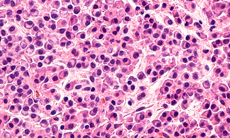 Multiple myeloma