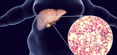 NAFLD