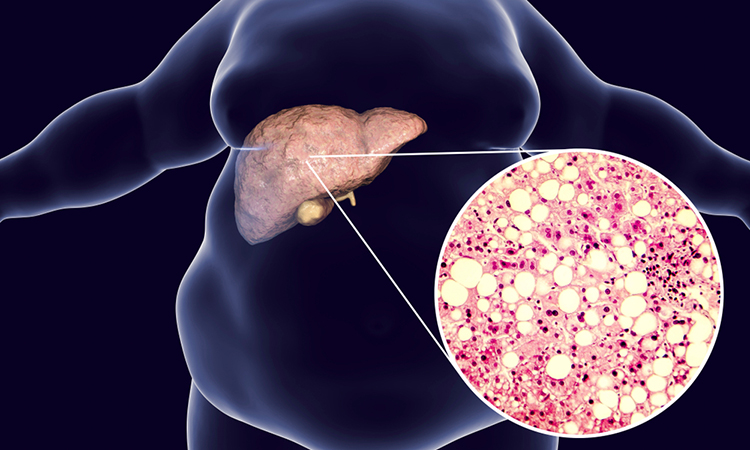 NAFLD