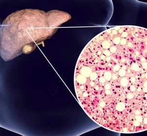 NAFLD