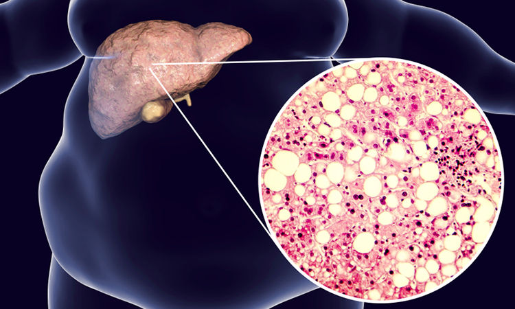 NAFLD