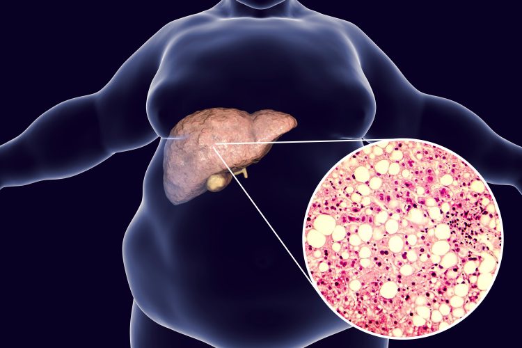 obese man with liver highlighted in pink and a cutaway to NASH pathology under a microscope