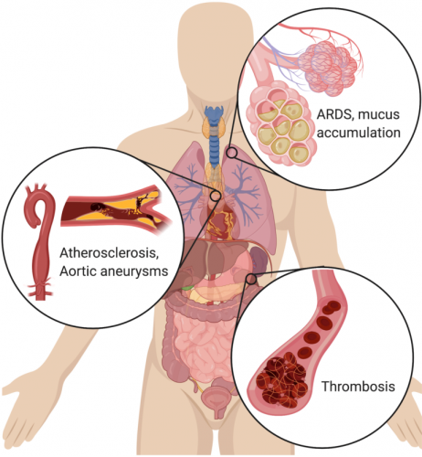 Symptoms NETs can cause, including atherosclerosis, aortic aneurisms, mucus buildup in the lungs, ARDS and thrombosis