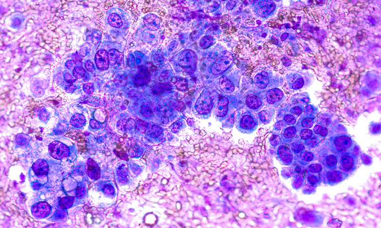 Non-small cell lung cancer