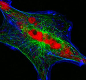 Neuroblastoma