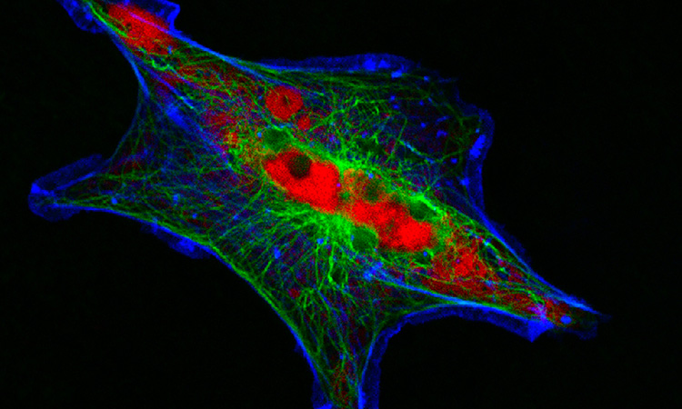 Neuroblastoma