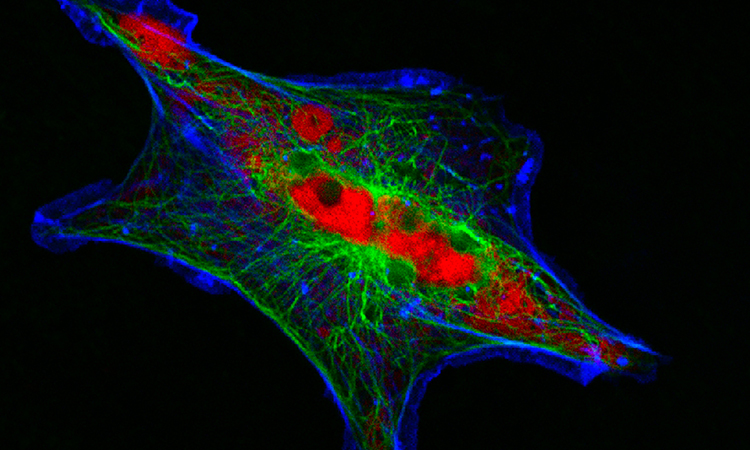 Neuroblastoma