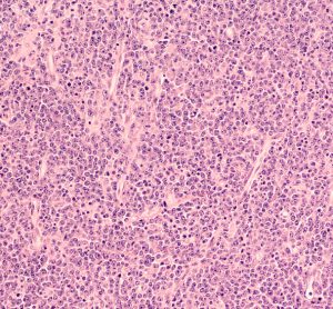 Mantle Cell Lymphoma