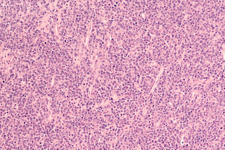 Mantle Cell Lymphoma