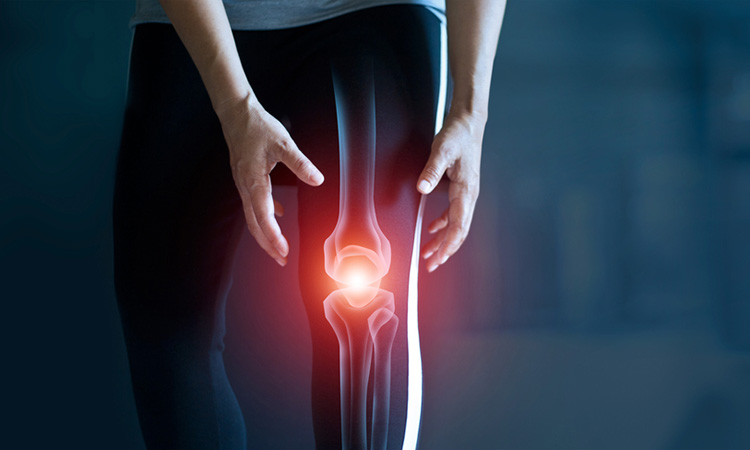 Osteoarthritis