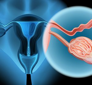Ovarian cancer