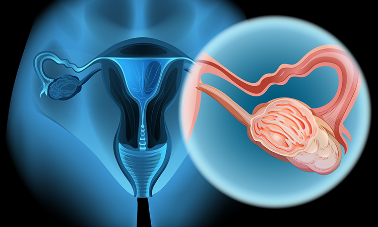 Ovarian cancer