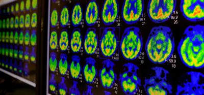 brain metastases