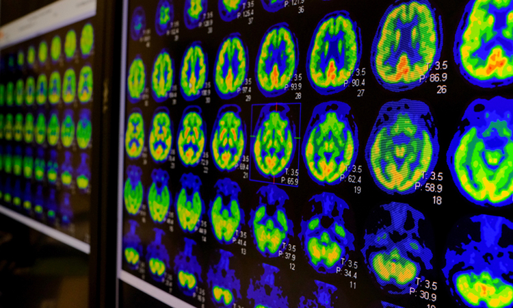 brain metastases