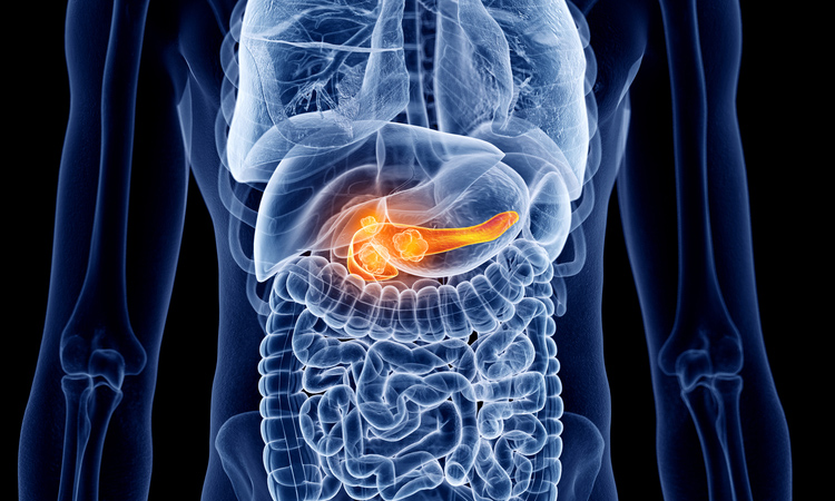 Pancreatic cancer