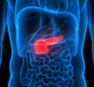 Pancreatic cancer