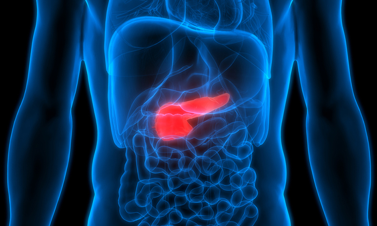 Pancreatic cancer