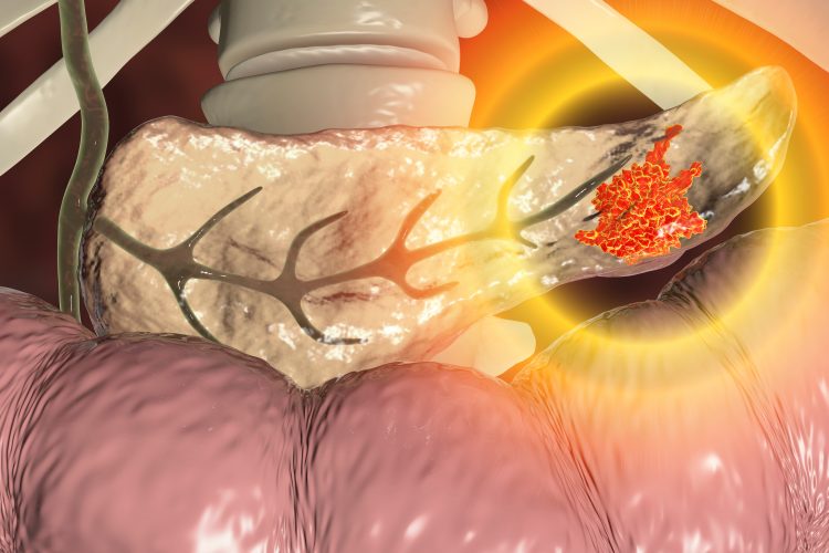 cartoon pancreas with red 'tumour' highlighted