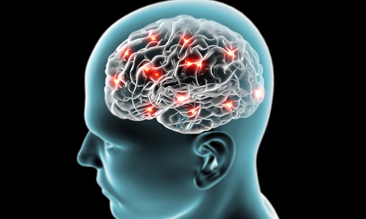 Brain with Parkinson's