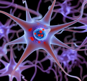 3D rendering of neurons containing alpha-synuclein Lewy Bodies