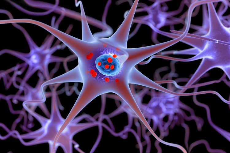 3D rendering of neurons containing alpha-synuclein Lewy Bodies