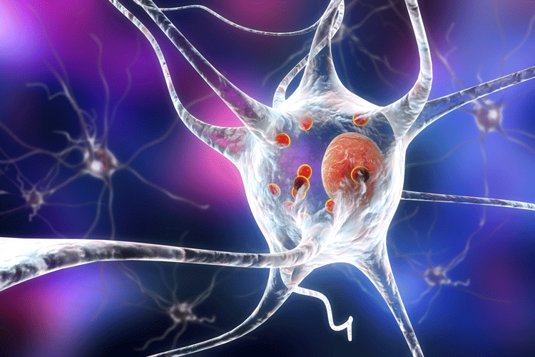 Parkinson's Disease dopamine neuron with alpha-synuclein Lewy Body inside