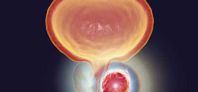 Prostate cancer