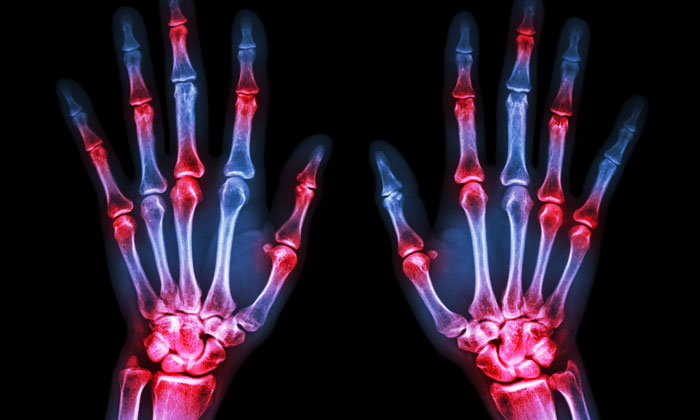 RA-hand-xray-screening