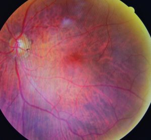 Retinopathy