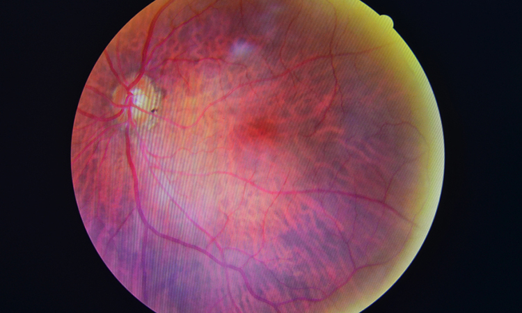 Retinopathy