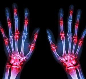 X-ray of the back of human hands with joints highlighted in red - idea of joint inflammation due to arthritis
