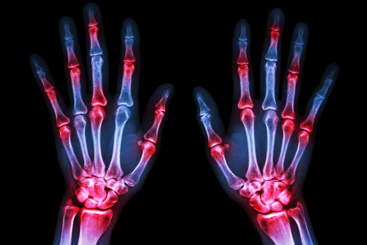 X-ray of the back of human hands with joints highlighted in red - idea of joint inflammation due to arthritis