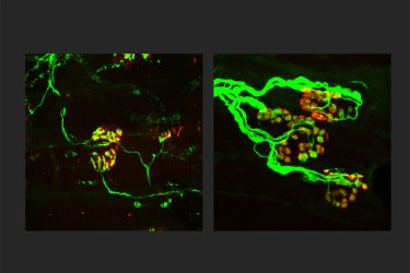Researchers at Washington University School of Medicine in St. Louis are working toward a treatment for neurodegenerative diseases that targets SARM1, a key molecule in the death of axons, the wiring of the nervous system. Shown, the axons (green) are thinner in a rodent model of an inherited axonal peripheral neuropathy (left). When SARM1 is missing from rodents with the disorder, the axons are thicker (right) and indistinguishable from normal, healthy axons. Finding ways to block SARM1 could lead to new therapies for a broad range of neurodegenerative diseases