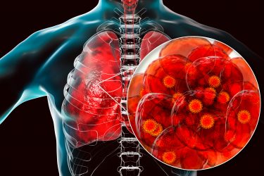 SARS-CoV-2 viral particles in a lung alveoli