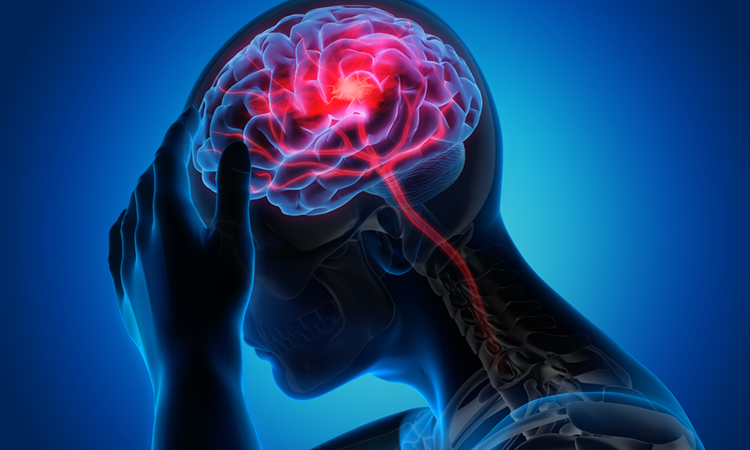 person with a headache - Stroke -3D Illustration