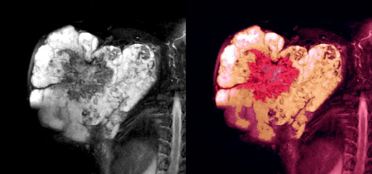 Sarcoma