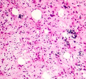 Sarcoma cancer tissue